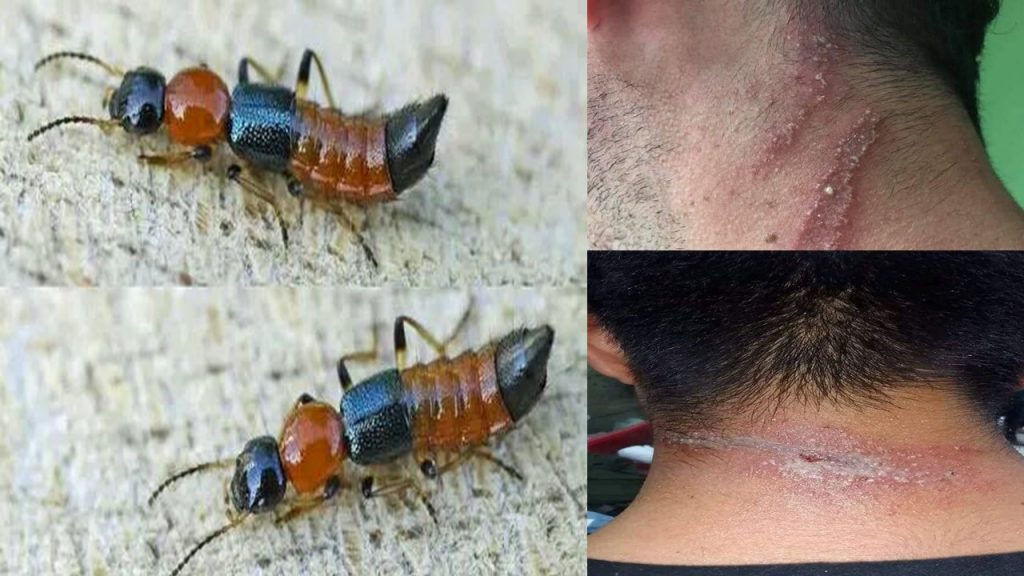 नाइरोबी फ्लाइको कीराबाट निस्केको सङ्क्रमणले भए पाँच जना बिरामी