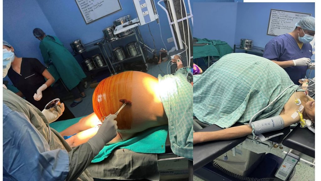 तीस किलोग्राम ‘ट्युमर’ को सफल शल्यक्रिया