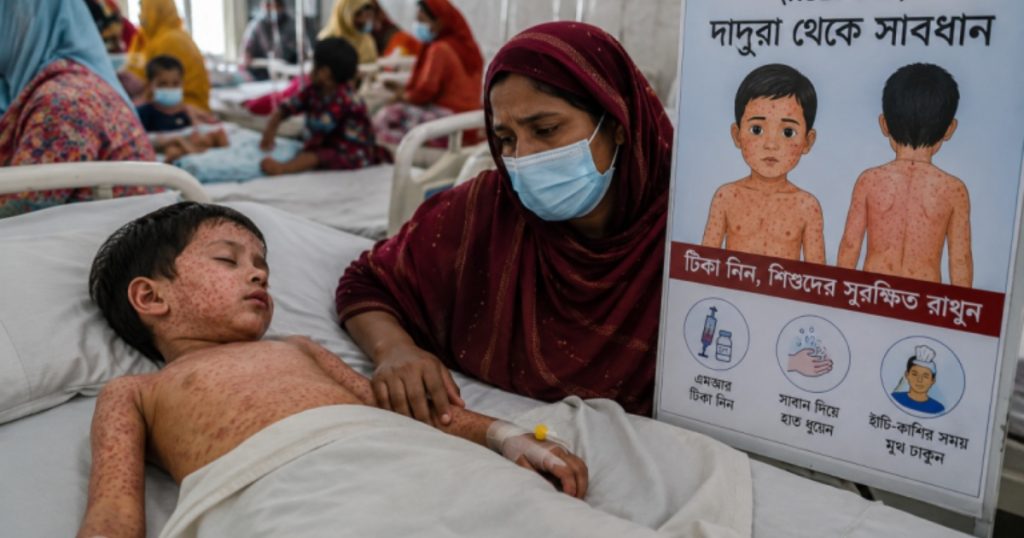 बङ्गलादेशमा दादुरा महामारी : साढे दुई महिनामा ५०० भन्दा बढी बालबालिकाले ज्यान गुमाए